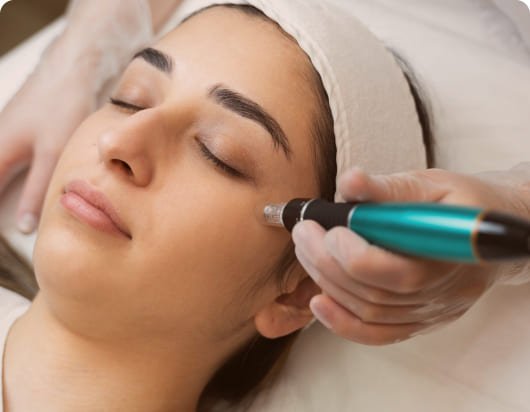 Acne Scars & Marks